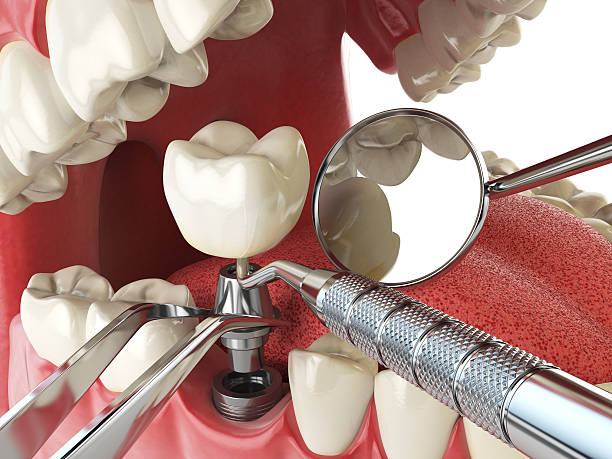 Tooth Infection Emergency Dentist in IL